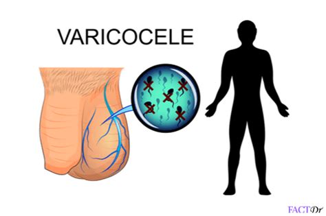 Varicocele Pain Swelling Stds Infection And Treatment Factdr