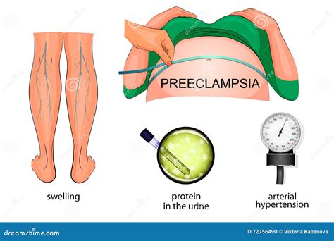 Preeclampsia Pregnancy Medical Health Treatment Life Pregnant Vector Illustration