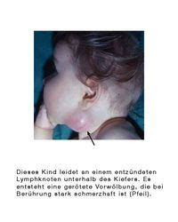 95 prozent der bevölkerung tragen das virus in sich. Lymphknotenvergrösserung, Lymphknotenschwellung - eesom ...