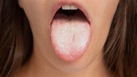 Why Does Your Tongue Suddenly Taste Sour Expert Explains Onlymyhealth
