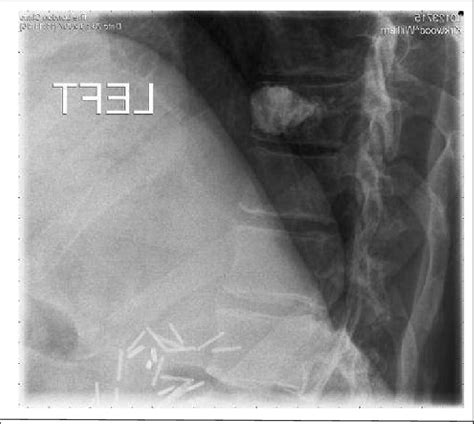 A Postoperative Lateral Plain Radiograph Of Patient 3 Showing The
