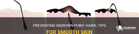 Preventing Ingrown Pubic Hairs Tips For Smooth Skin Shunhair