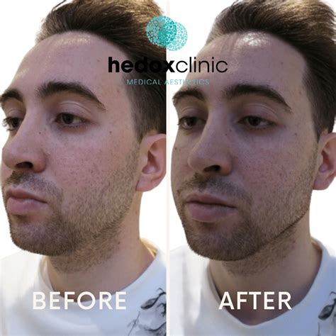 Weak Chin Treatment London Jawline Fillers Hedox Clinic