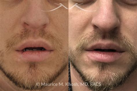 New York Facial Plastic Surgery Scar Revision Laceration Repair