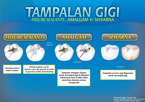 Klinik gigi joy dental yogyakarta adalah salah satu klinik gigi di daerah istimewa yogyakarta dan purwokerto yang menyediakan pelayanan perawatan gigi dan mulut umum dan. Klinik Pergigian Balik Pulau: KENALI JENIS TAMPALAN PADA ...