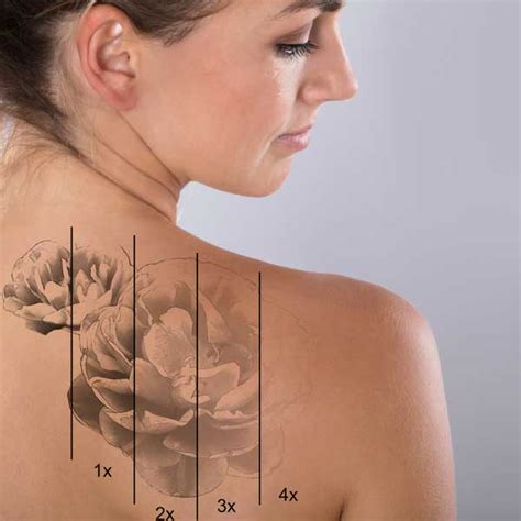 Tattoo removal machines for sale in south africa. Laser Tattoo Removal | Ageless Medical | Premier Medspa ...