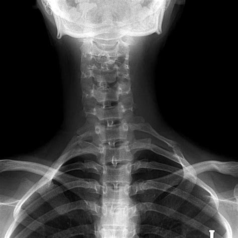 Pdf Cervical Rib Syndrome 2 Cases Report