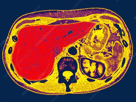 Human Liver Stock Image C0271036 Science Photo Library