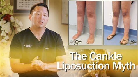Lipedema Surgery Cankle Liposuction Expert Dr Thomas Su Artlipo Liposuction Lipedema