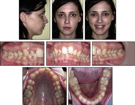 Orthodontic Orthognathic Surgical Treatment In A Patient With Class Ii