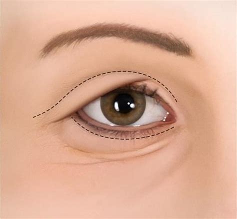 Eyelid Surgery Dr Ashok Govila