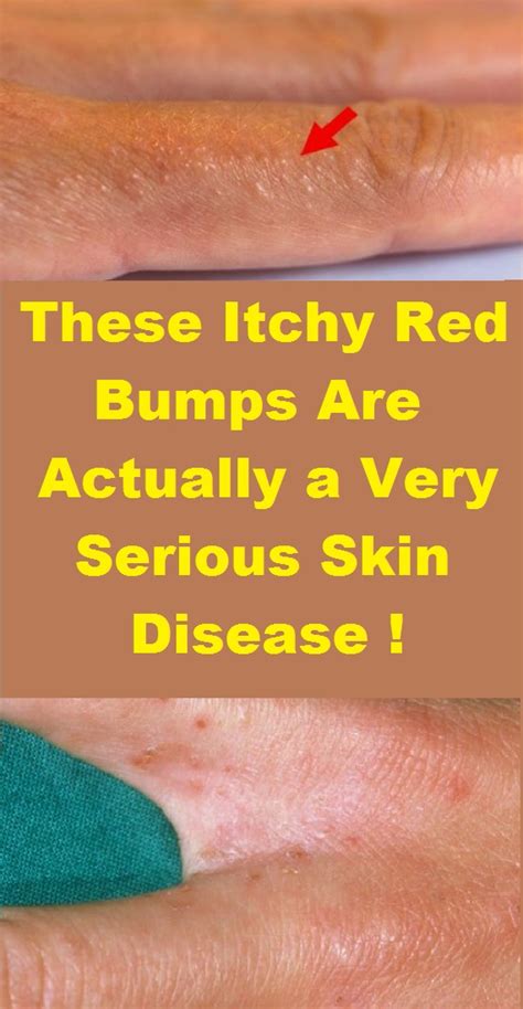 These Itchy Red Bumps Are Actually A Very Serious Skin Disease