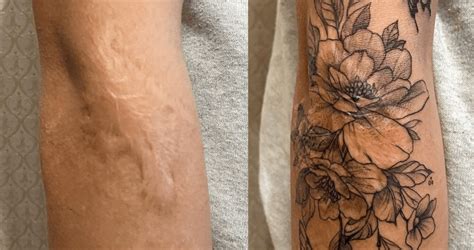 What To Know About Using Tattoos To Cover Scars Removery
