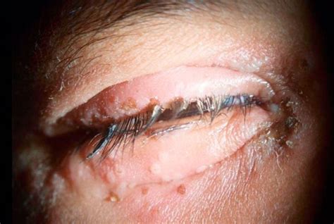Conjunctival Geographic Ulcer And Blepharitis In Primary Ocular Herpes