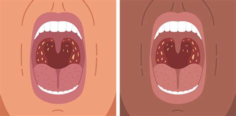 Struggling With Bad Breath You Might Have Tonsil Stones Healthy