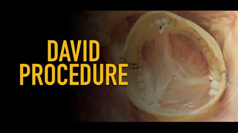 David Procedurevalve Sparing Aortic Root Replacementaortic Aneurysm
