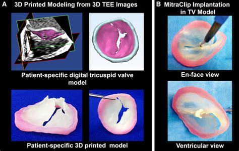 Tricuspid Valve