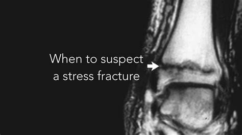 When To Suspect A Stress Fracture RunningPhysio