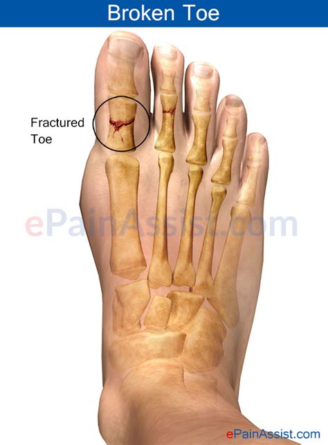 Broken Toe Or Fractured Toetreatmentsymptomsrecoveryprognosis