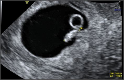 Why do you need a 6 weeks pregnant ultrasound? Pregnancy Week 6