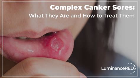 complex canker sores what they are and how to treat them youtube