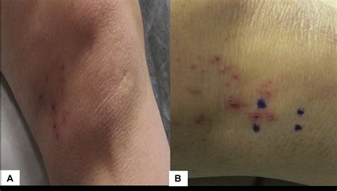 Dermatitis Herpetiformis With Fibrillar Iga Deposition And Unusual