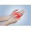 Carpal Tunnel Hand Pain Numbness  Physical Therapy