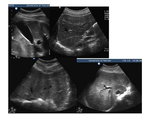 Liver Segment Ultrasound