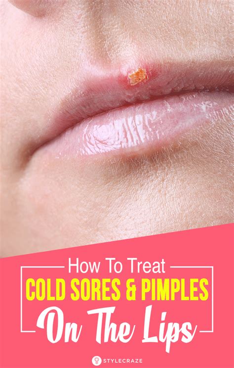 Cold Sores Vs Pimples Symptoms Causes And Treatment How To Treat
