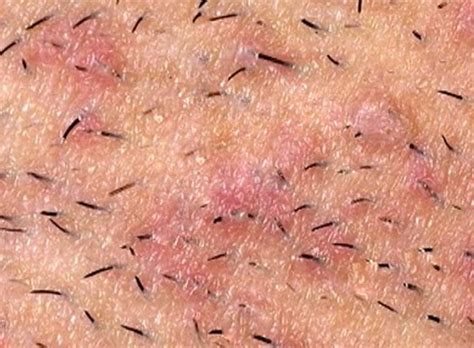 Infected Ingrown Hair Pictures Symptoms Treatment Removal