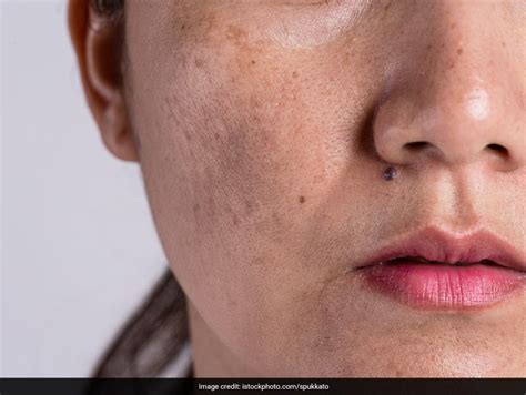 Skin Pigmentation Easy Home Remedies To Tackle This Common Beauty Problem