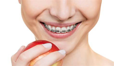 How Can Braces Fix An Overbite Treatment Options And Duration