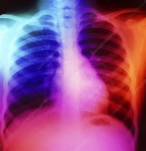 False Colour Chest X Ray Normal 7 Year Old Child Stock Image P590
