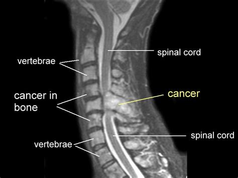 Spinal Cord Syndrome