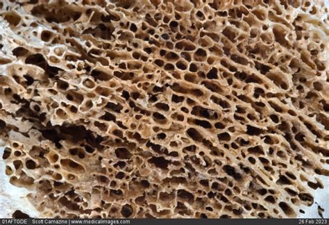Stock Image Close Up Of A Normal Human Femur Showing The Spongy