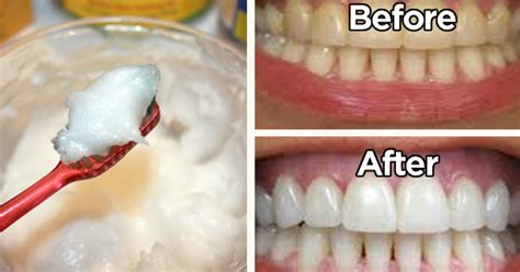 6 Simple Ways To Naturally Whiten Your Teeth At Home With Baking Soda
