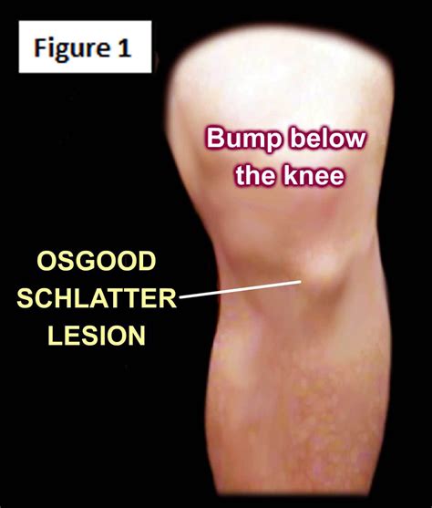 Osgood Schlatter Disease Osgood Schlatter Disease Knee Pain Relief