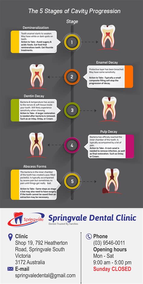 Stages Of Cavity Progression Symptops Causes Treatment