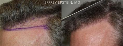 Hair Transplants For Men Photos Miami FL Patient38596