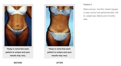 Best Tummy Tuck Surgeon Denver Cosmetic Surgery Tips