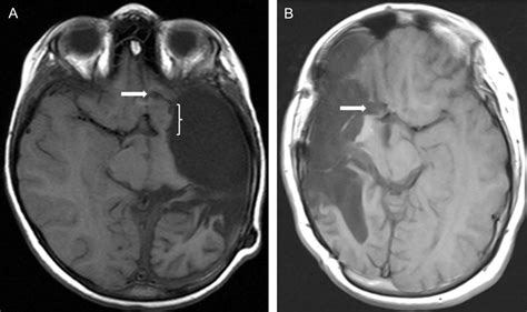 Fifty Consecutive Hemispherectomies Neurosurgery Blog