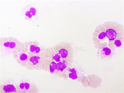 Acute Promyelocytic Leukemia Cells Or Apl Stock Image Image Of Acute