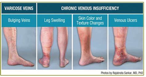 Is Your Leg Pain Venous Insufficiency Cvr Blog Usa