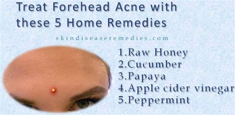 5 Effective Home Remedies For Forehead Acne Skin Disease Remedies
