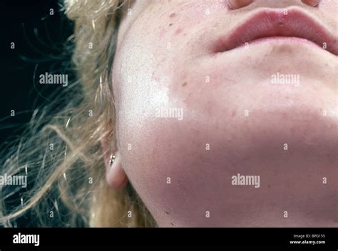 Girl With A Swollen Jaw Due To A Dental Abscess Stock Photo Alamy