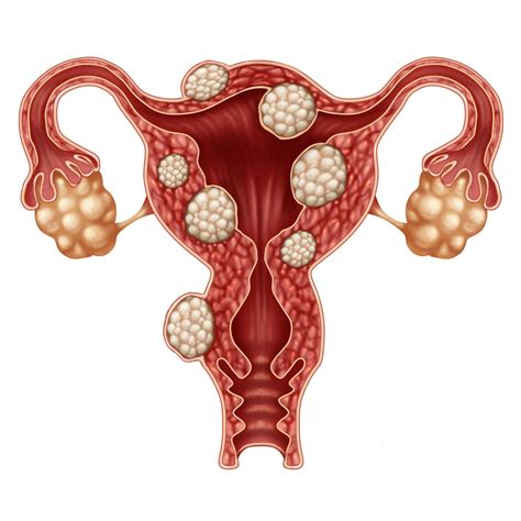Sex Hurts Part Fibroids And Endometriosis Nurture Women S Health