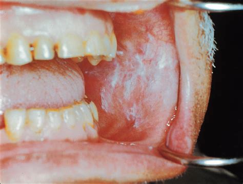 White Oral Lesions How To Distinguish The Benign From The Deadly 2023