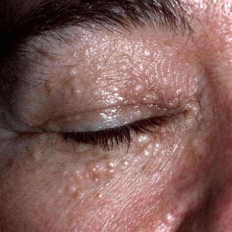 So Long Syringoma How To Get Rid Of Bumps Under The Eyes
