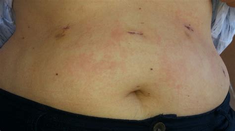 Itchy Rash On Stomach Belly Button Rash Causes And Symptoms Medicaverse A Rash Is A