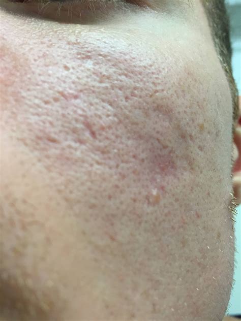 Skin Concerns Not Taken Seriously By Dermatologists Redness Large